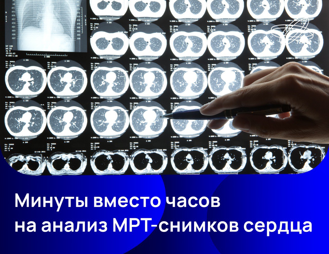 Быстро определять фиброз сердца по МРТ-снимкам поможет алгоритм на основе глубокого обучения